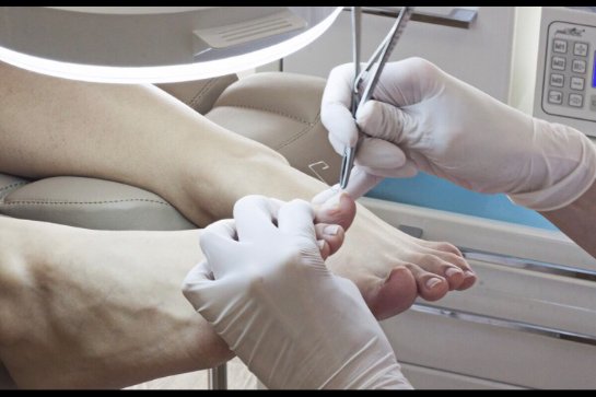 Безболезненное лечение вросшего ногтя в Украине