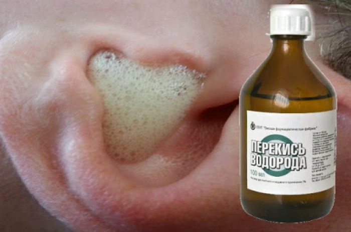 Как избавиться от ушной серы с помощью перекиси водорода