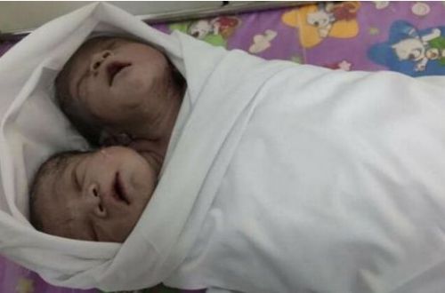В Мьянме родился ребенок с двумя головами: малыша не признали сиамским близнецом. ФОТО